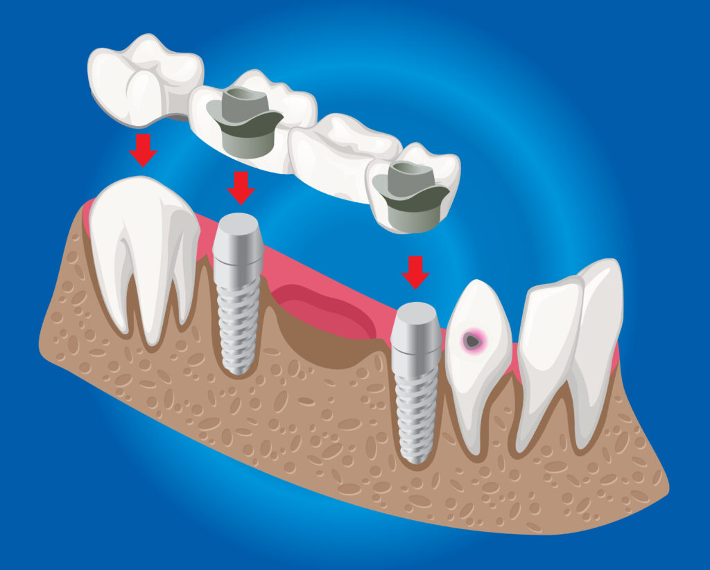 Implant retained Dentures